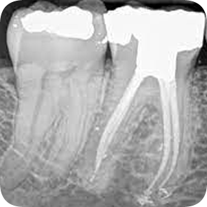 Root Canal Treatment