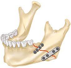 Treatment of fractures