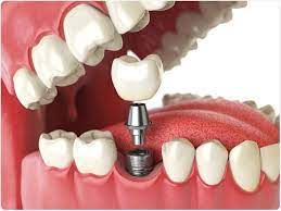 Dental Implant prosthesis