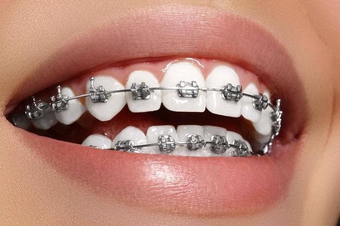 Orthodontic Braces Patiala city