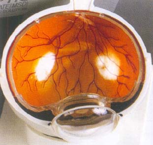 Chitin Ophthalmology Grade